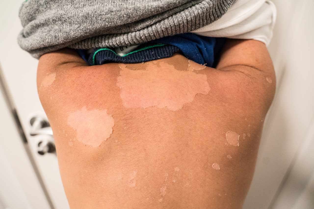 Soothe your sunburn with expert’s bathtub remedy – get it to a dark amber hue, plus 4 other soaks to make skin better